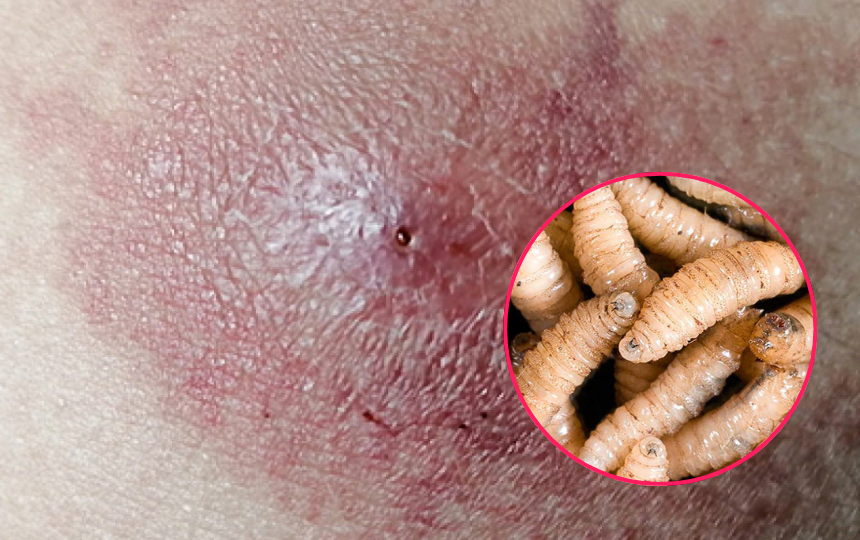 Fallece adulto mayor por miasis en Oaxaca